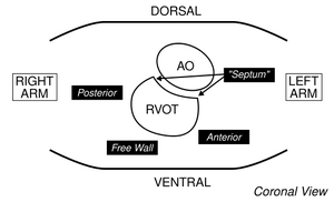 Ablation.svg